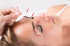 Cosmetische acupunctuur of facial acupunctuur en huid gezicht verstevigen en strakker maken